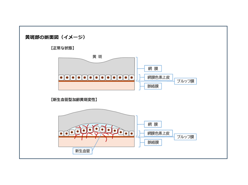 既存治療に抵抗性の新生血管型加齢黄斑変性におけるヒト(同種)皮下脂肪組織由来間葉系幹細胞シート(PAL-222)移植の第Ⅰ/Ⅱa相臨床試験(治験)(試験名:PRESERVE試験)の治験開始について