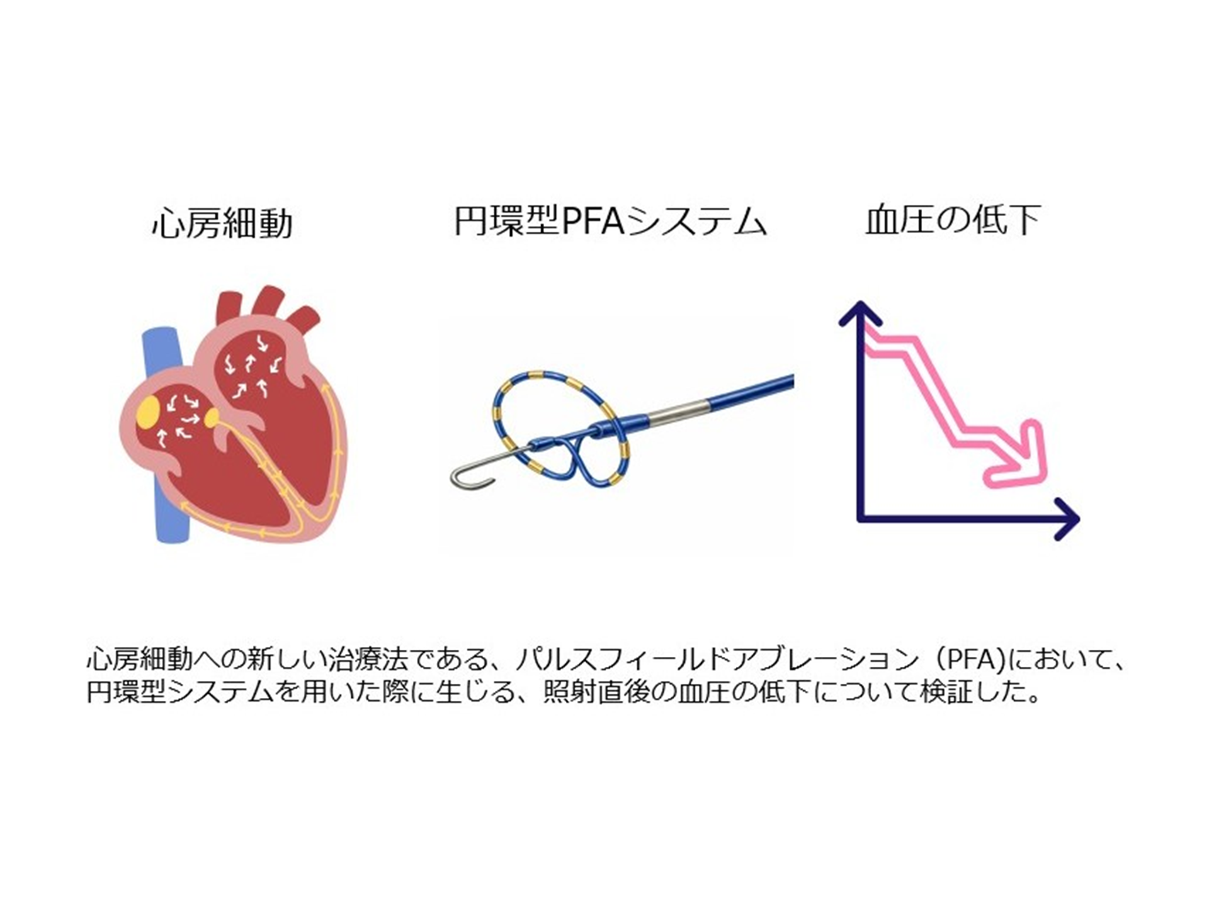 Incidence and risk factors of acute blood pressure drops during circular-array pulsed-field ablation for pulmonary vein isolation
