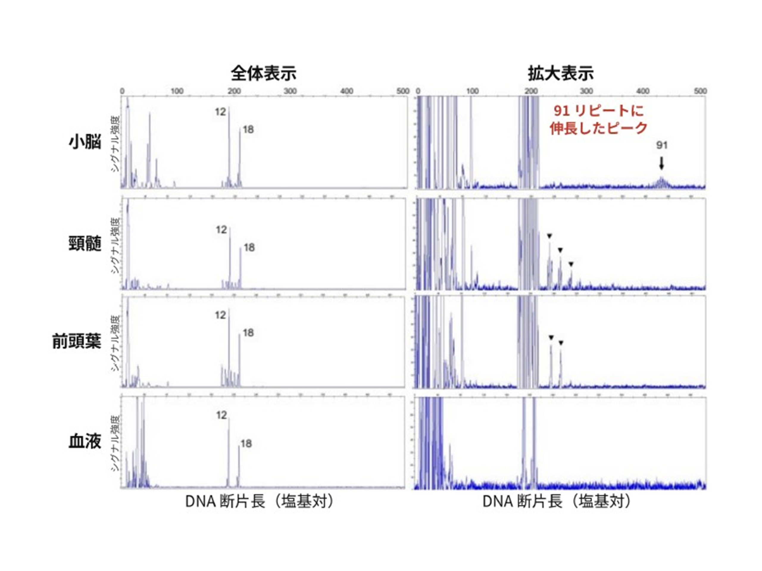 神経難病「多系統萎縮症」に関わる新たな遺伝子変化を発見